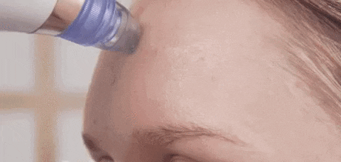 PoreCleanser Pro - Blackhead Vacuum