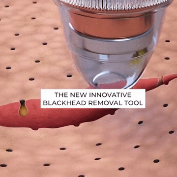 PoreCleanser Pro - Blackhead Vacuum